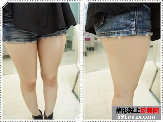 自体脂肪丰胸后不仅胸丰满 腿也细了不少