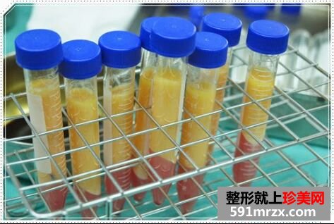 自体脂肪丰胸后不仅胸丰满 腿也细了不少