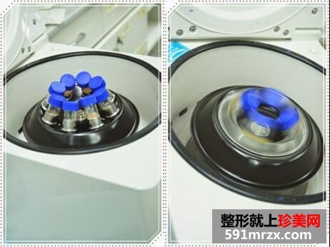 自体脂肪丰胸后不仅胸丰满 腿也细了不少