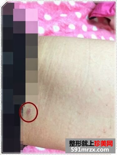 自体脂肪丰胸后不仅胸丰满 腿也细了不少
