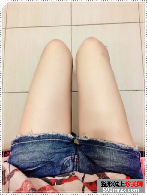 自体脂肪丰胸后不仅胸丰满 腿也细了不少