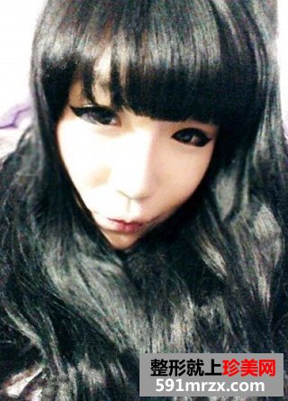 高颧骨整形手术恢复过程和前后对比照