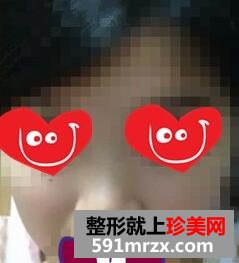 隆鼻前图片