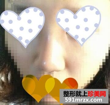 玻尿酸隆鼻第二天