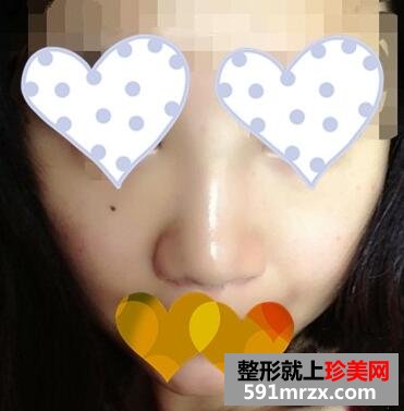 玻尿酸隆鼻恢复过程图