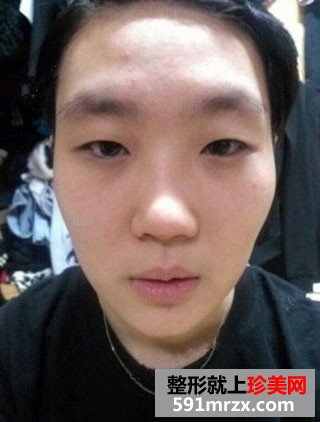 高颧骨整形手术恢复过程和前后对比照