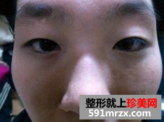 高颧骨整形手术恢复过程和前后对比照
