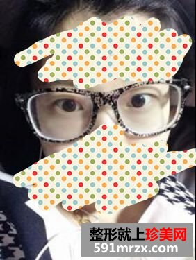 看看我刚割双眼皮五天的效果怎么样