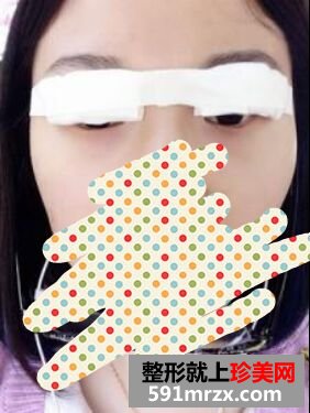 看看我刚割双眼皮五天的效果怎么样