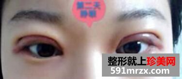 看看我刚割双眼皮五天的效果怎么样