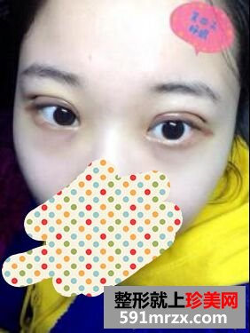 看看我刚割双眼皮五天的效果怎么样