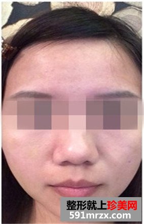 王者之冠光子嫩肤有副作用吗？来围观我的前后对比效果照片吧！