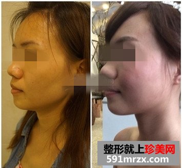 王者之冠光子嫩肤有副作用吗？来围观我的前后对比效果照片吧！