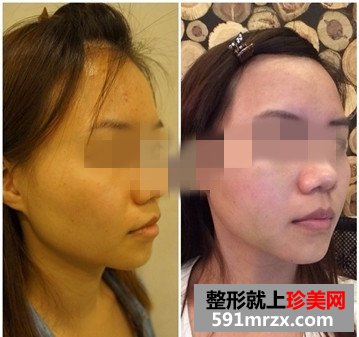 王者之冠光子嫩肤有副作用吗？来围观我的前后对比效果照片吧！