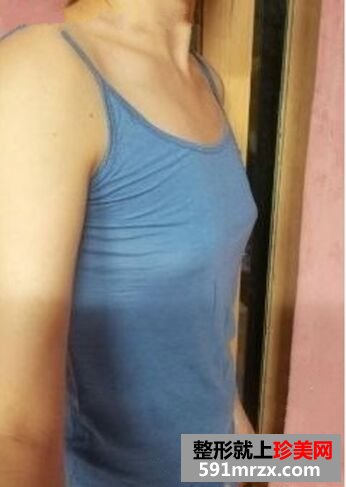 360cc硅胶假体隆胸让我平胸变丰满大胸