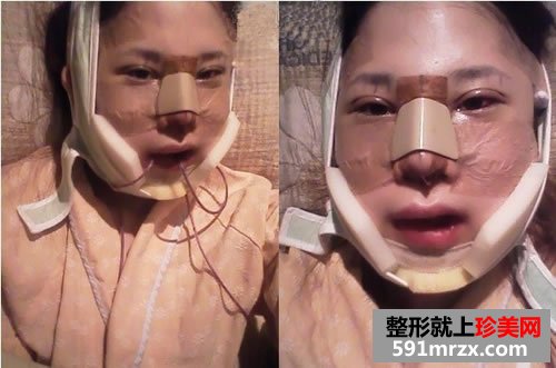 面部综合整形手术前后对比照片分享和恢复经历