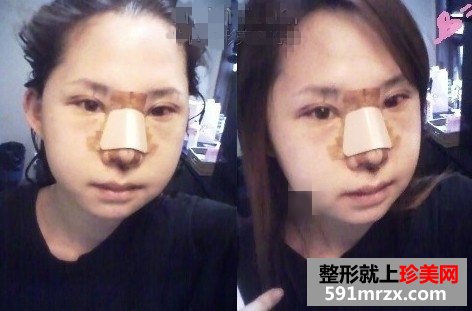 面部综合整形手术前后对比照片分享和恢复经历