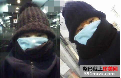 面部综合整形手术前后对比照片分享和恢复经历