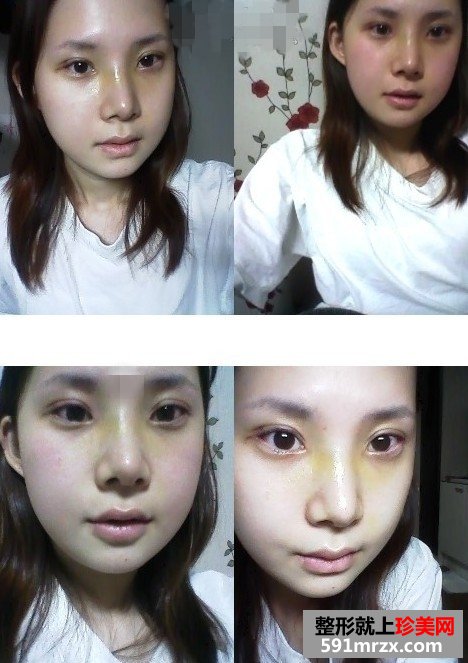 面部综合整形手术前后对比照片分享和恢复经历