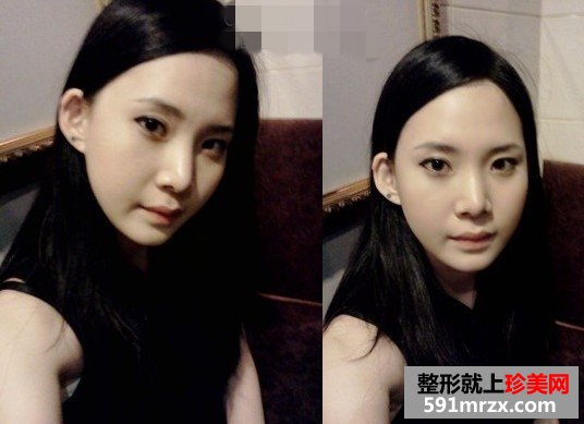 面部综合整形手术前后对比照片分享和恢复经历