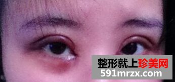 小眼睛做了双眼皮+开眼角后恢复照片