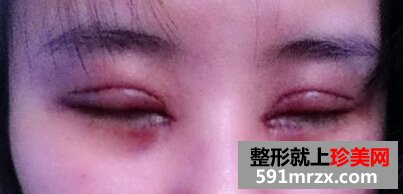 小眼睛做了双眼皮+开眼角后恢复照片