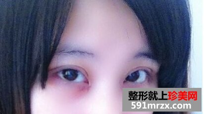 小眼睛做了双眼皮+开眼角后恢复照片