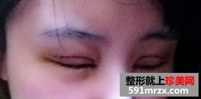 小眼睛做了双眼皮+开眼角后恢复照片