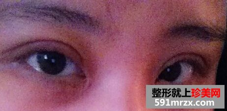小眼睛做了双眼皮+开眼角后恢复照片