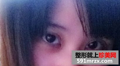 小眼睛做了双眼皮+开眼角后恢复照片