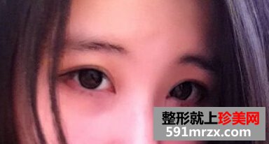 小眼睛做了双眼皮+开眼角后恢复照片
