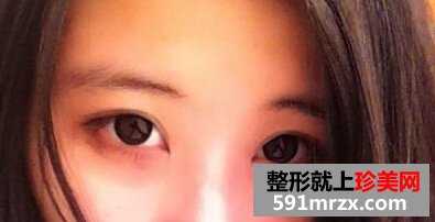 小眼睛做了双眼皮+开眼角后恢复照片