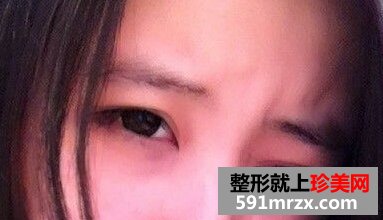 小眼睛做了双眼皮+开眼角后恢复照片