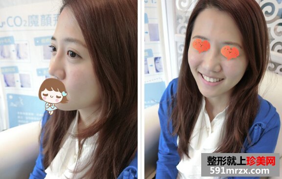 打玻尿酸后 苹果肌饱满鼻子也变翘了！