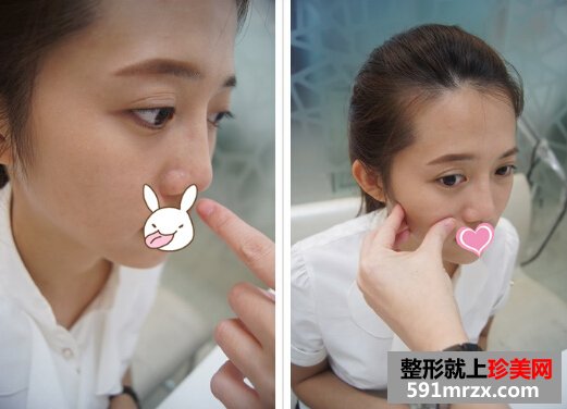 打玻尿酸后 苹果肌饱满鼻子也变翘了！