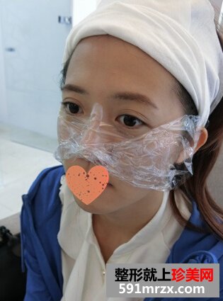 打玻尿酸后 苹果肌饱满鼻子也变翘了！