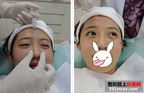 打玻尿酸后 苹果肌饱满鼻子也变翘了！