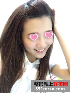 打玻尿酸后 苹果肌饱满鼻子也变翘了！