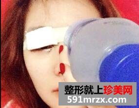 上海的华美整形医院做全切双眼皮和开眼角