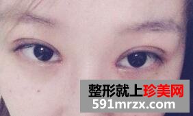 全切双眼皮和开眼角