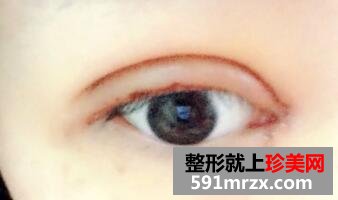 全切双眼皮和开眼角恢复过程图