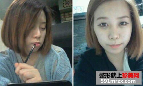 微创颧骨缩小+无下巴整形手术前后效果对比图和恢复过程