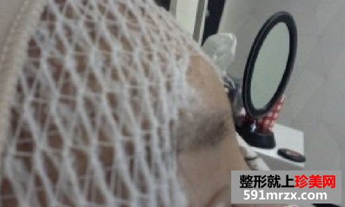 微创颧骨缩小+无下巴整形手术前后效果对比图和恢复过程