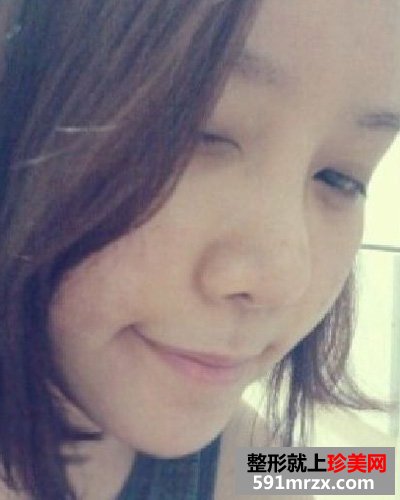 微创颧骨缩小+无下巴整形手术前后效果对比图和恢复过程
