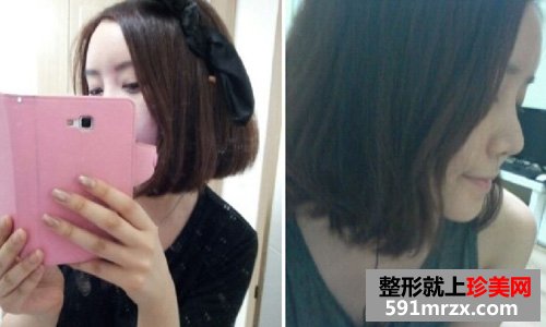 微创颧骨缩小+无下巴整形手术前后效果对比图和恢复过程