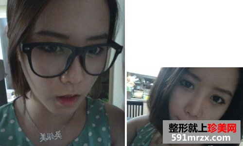 微创颧骨缩小+无下巴整形手术前后效果对比图和恢复过程