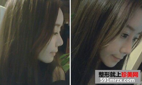 微创颧骨缩小+无下巴整形手术前后效果对比图和恢复过程