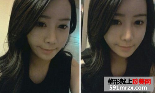 微创颧骨缩小+无下巴整形手术前后效果对比图和恢复过程
