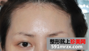 自体毛发无痕植眉前后效果对比图和恢复过程