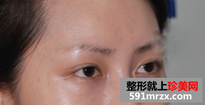 自体毛发无痕植眉前后效果对比图和恢复过程